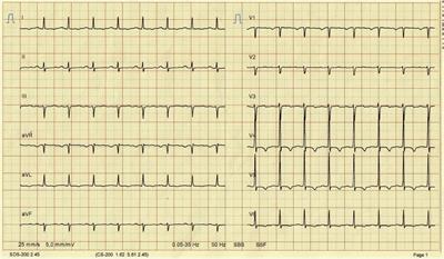 Mitral stenosis in a teenager after rheumatic mitral valve regurgitation valve repair: A case report